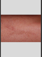 After Photo PicoWay Tattoo Removal of Barb Wire - Prejuvenation Before & After