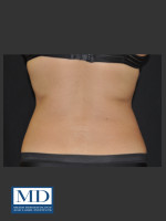 After Photo  Body Contouring Treatment 141 - Prejuvenation Before & After