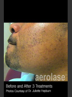 After Photo Hair Removal #314 - Prejuvenation Before & After