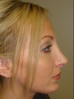After Photo Rhinoplasty 6574 - Prejuvenation Before & After