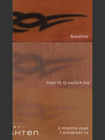 After Photo Tattoo Removal on Lower Back - Prejuvenation Before & After
