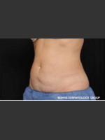 After Photo CoolSculpting Treatment of Woman's Abdomen - Prejuvenation Before & After