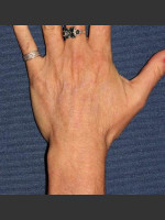 After Photo Sun Spot Removal on Hands - Prejuvenation Before & After