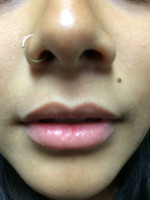 Before Photo Juvederm Injection  - Prejuvenation Before & After