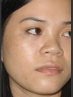 After Photo Quanta MDK Treatment of Pigment #78 - Prejuvenation Before & After