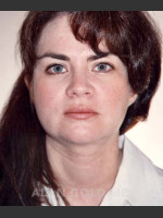 After Photo Liposuction of Neck 96 - Prejuvenation Before & After