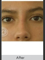 After Photo Undereye Filler - Prejuvenation Before & After