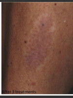 After Photo Treatment of Tattoo - Prejuvenation Before & After