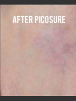 After Photo Treatment of Tattoo with Picosure - Prejuvenation Before & After
