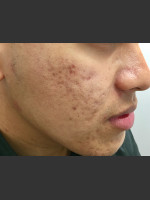 Before Photo Microneedling  - Prejuvenation Before & After