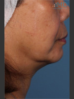 Before Photo Ultherapy Skin Laxity Treatment of Lower Face - Prejuvenation Before & After