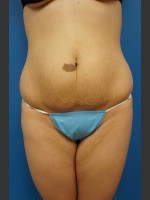 Before Photo Abdominoplasty (Tummy Tuck) Before & After - Prejuvenation Before & After