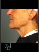 After Photo Ultherapy on Mid Face with Dermal Fillers - Prejuvenation Before & After