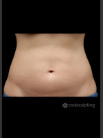 Before Photo CoolSculpting on Woman's Stomach - Prejuvenation Before & After