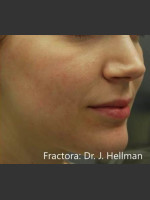 After Photo Fractora #1 - Prejuvenation Before & After