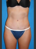 After Photo Tummy Tuck Case #2 - Prejuvenation Before & After