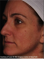 After Photo Facial Skin Rejuvenation with Clear and Brillant Permea - Prejuvenation Before & After