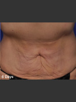 After Photo ThermiTight Treatment - Prejuvenation Before & After