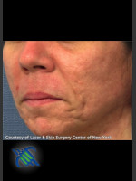 Before Photo Treatment of Lower Face Acne Scarring - Prejuvenation Before & After