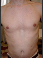 After Photo Quanta Light Series Laser Hair Removal #74 - Prejuvenation Before & After