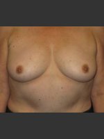 Before Photo Breast Augmentation  - Prejuvenation Before & After