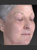 After Photo Deep Wrinkle Reduction - Prejuvenation Before & After