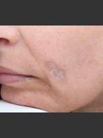 Before Photo Traumatic scar  - Prejuvenation Before & After