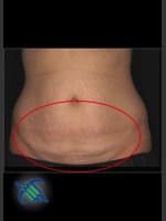 Before Photo Treatment of Abdomen with CoolSculpting - Prejuvenation Before & After