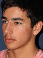 After Photo Treatment of Acne  - Prejuvenation Before & After