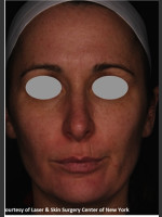 After Photo Full face Treament with Fraxel - Prejuvenation Before & After