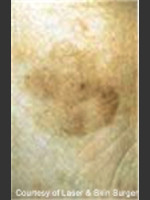 Before Photo Treatment of Facial Pigmentation - Prejuvenation Before & After