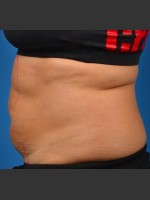 Before Photo SculpSure Abdomen - Prejuvenation Before & After