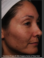 Before Photo Treatment of Melasma - Prejuvenation Before & After