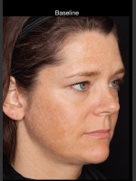 Before Photo Hyperpigmentation - Professional Peel - Prejuvenation Before & After