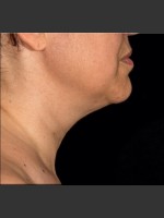 After Photo SculpSure Submental - Prejuvenation Before & After