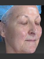 Before Photo Deep Wrinkle Reduction - Prejuvenation Before & After