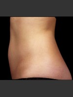 After Photo SculpSure Abdomen - Prejuvenation Before & After