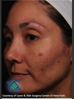 Before Photo Pigment Facial Skin Rejuvenation - Prejuvenation Before & After