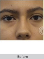 Before Photo Undereye Filler - Prejuvenation Before & After