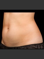 Before Photo SculpSure Abdomen - Prejuvenation Before & After