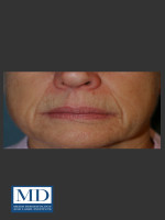 Before Photo Nasolabial Fold and Lip Filler 137 - Prejuvenation Before & After