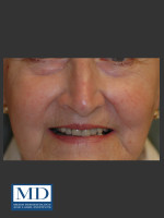 After Photo Rosacea Treatment 101 - Prejuvenation Before & After