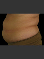 Before Photo Body Contouring Treatment #121 - Prejuvenation Before & After