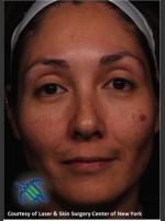Before Photo Treatment of Melasma - Prejuvenation Before & After