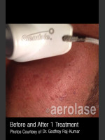 After Photo #306 - Treatment of Acne Scars - Prejuvenation Before & After