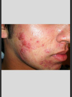 Before Photo elos Technology AC for Acne Treatment - Prejuvenation Before & After