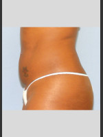 After Photo UltraShape Focused Ultrasound Female Abdomen - Prejuvenation Before & After