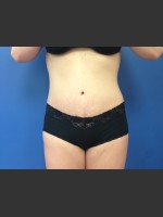After Photo Abdominoplasty (Tummy Tuck) Before & After - Prejuvenation Before & After