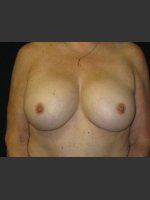 After Photo Breast Augmentation  - Prejuvenation Before & After
