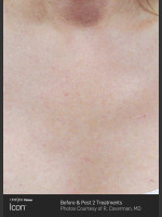 After Photo Skin Revitalization of Chest Using Icon - Prejuvenation Before & After